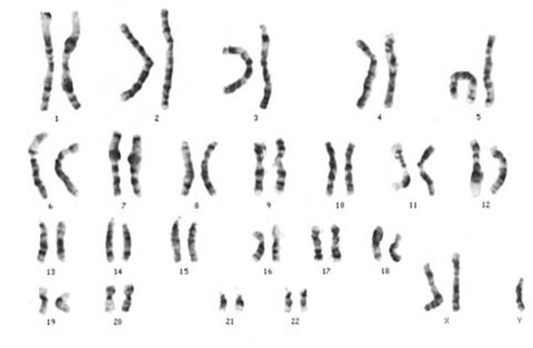 Figura 4. Cariótipo de um indivíduo do sexo masculino com síndrome de Klinefelter.