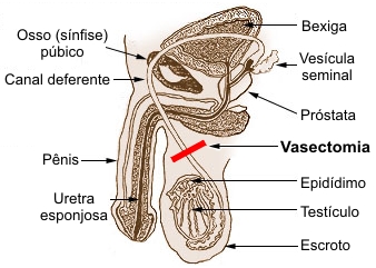 Figura 10. Vasectomia